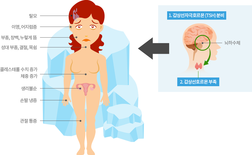 갑상선 저하증의 증상 탈모 이명, 어지럼증, 부종, 창백, 누렇게뜸, 성대 부종, 결절, 목쉼, 콜레스테롤 수치 증가, 체중증가, 생리불순, 손발 냉증, 관절통증