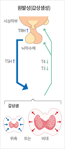 원발성(갑상샘성)